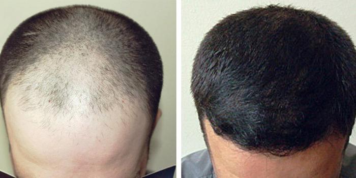 Наращивание волос у мужчин фото до и после