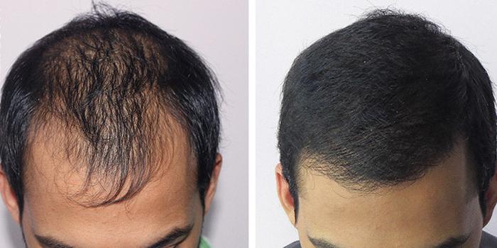 Наращивание волос для мужчин до и после