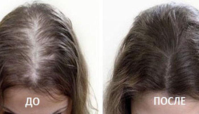 Уколы витамин в голову для роста волос