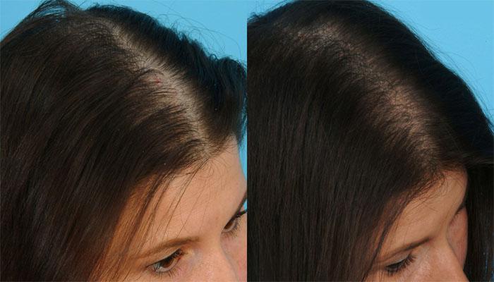 Мезотерапия при гормональном выпадении волос