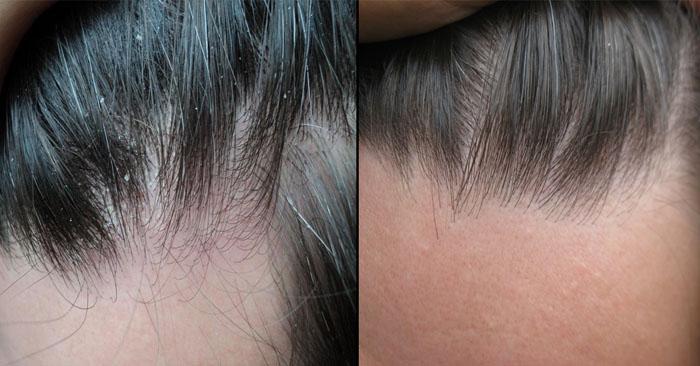 Чемеричная вода для роста волос до и после