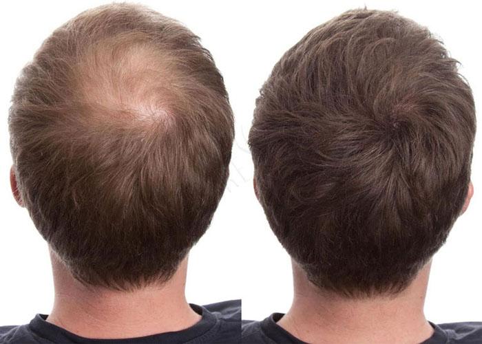 Генеролон для роста волос на голове у женщин