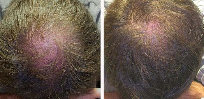 Помогает ли миноксидил для роста волос на голове