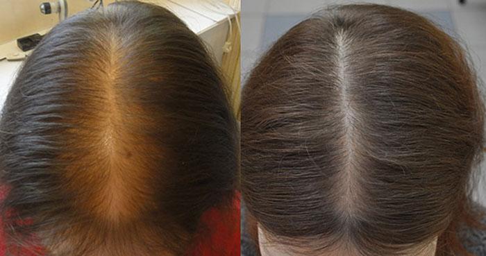 Миноксидил для роста волос противопоказания