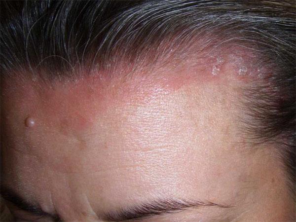 Болячки на коже головы лечение народными средствами