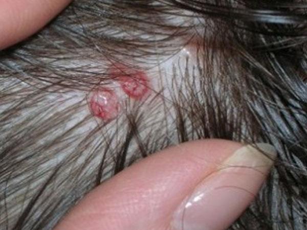Болячки на голове в волосах причины лечение в домашних thumbnail