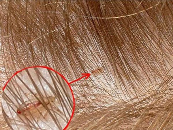 Как вылечить болячку в волосах