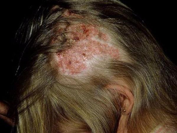 Как вылечить болячки на кожи головы