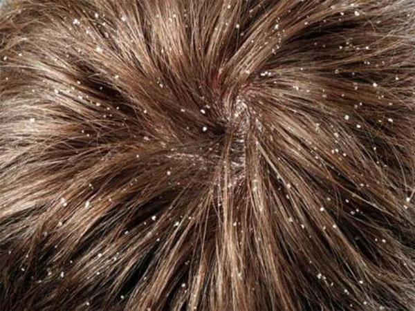 Как вылечить болячку в волосах