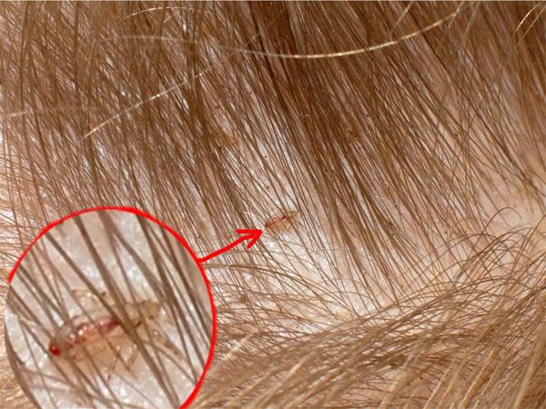 Зуд кожи головы перхоть выпадение волос лечение