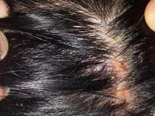 Перхоть зуд выпадение волос лечение в домашних условиях thumbnail