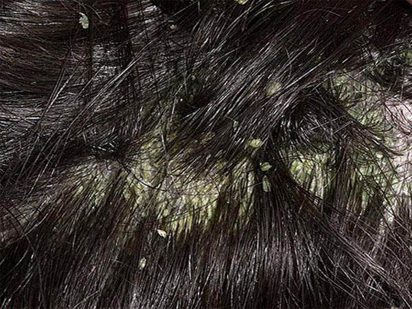 Зуд кожи головы перхоть выпадение волос лечение
