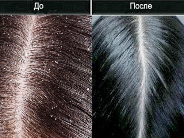 Трава против перхоти и выпадения волос