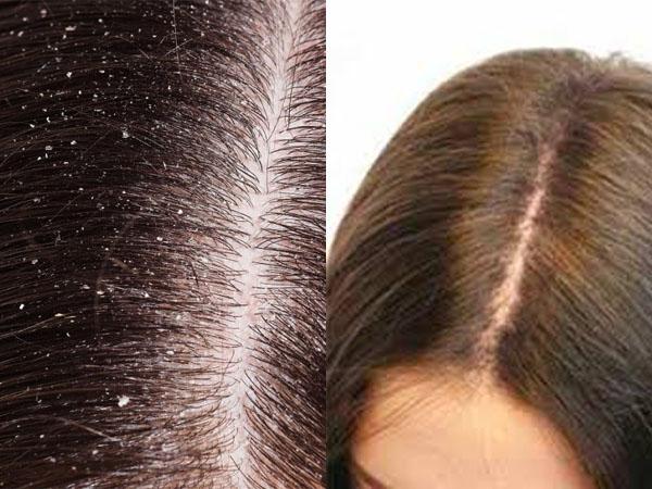 Отвары трав от перхоти и выпадения волос
