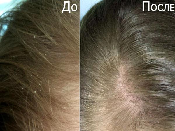 Яблочный уксус в лечении кожи головы