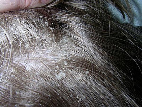Препарат для волос от перхоти и выпадения