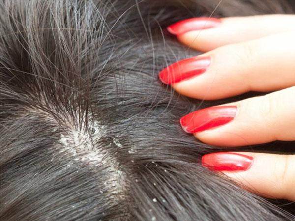 Как вылечить волосы от сухой себореи