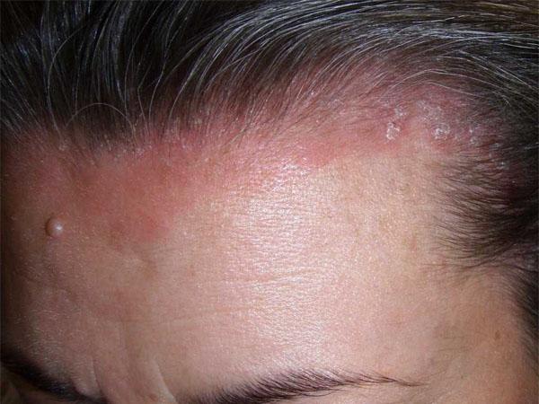 Псориаз кожи головы лечение мази