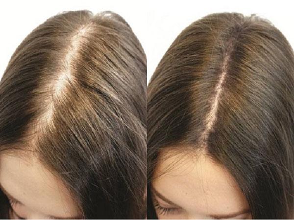 Криомассаж волос при выпадении волос