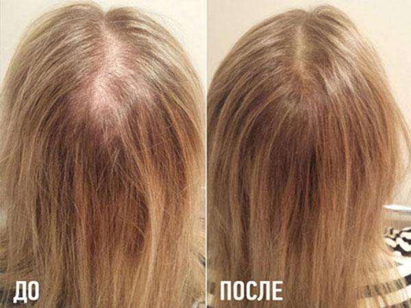 Криомассаж волос при выпадении волос