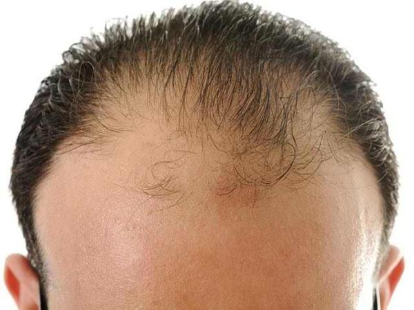 Андрогенное выпадение волос у мужчин лечение