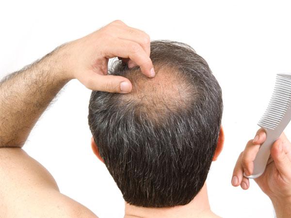 Выпадение волос у мужчин при избытке тестостерона