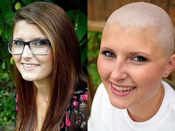 Признаки выпадения волос при химиотерапии