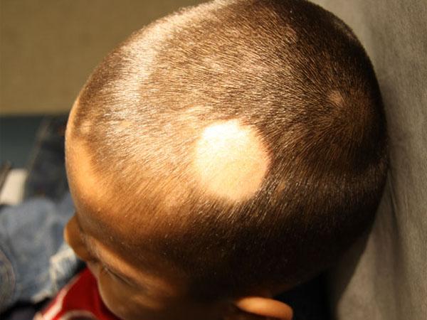 Выпадение волос у детей очаговой алопеции