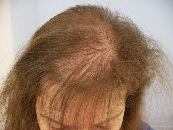 Выпадение волос у женщины фото