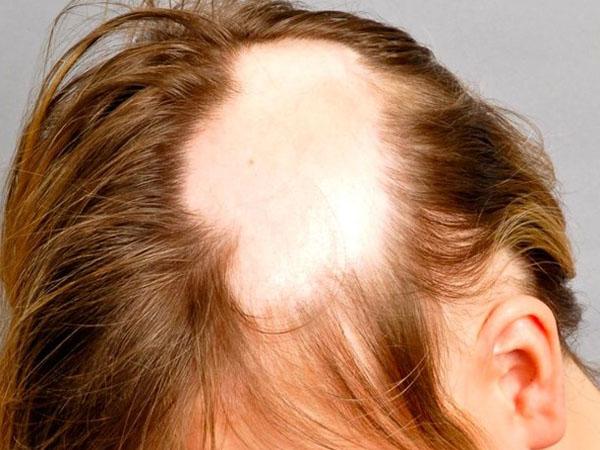 Что такое рубцовое выпадение волос