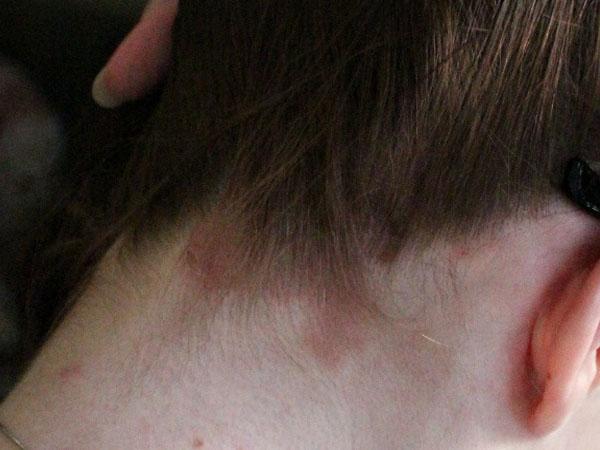 Как вылечить волосы от аллергии на краску для волос thumbnail