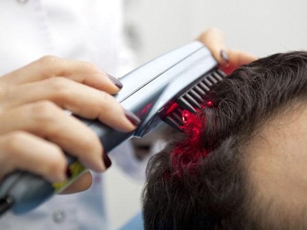 Эффективность лазерной терапии при выпадении волос