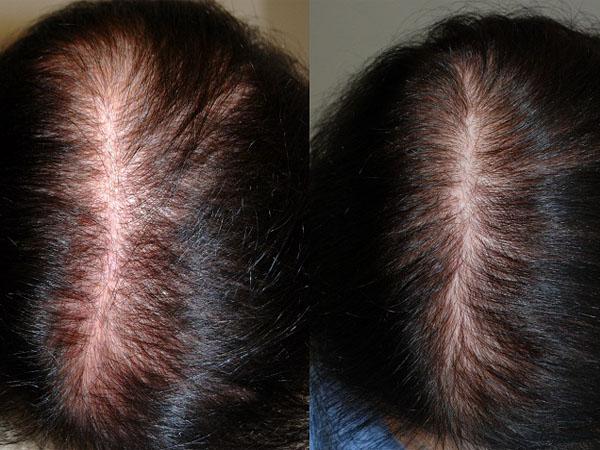 Лазерная терапия для кожи головы