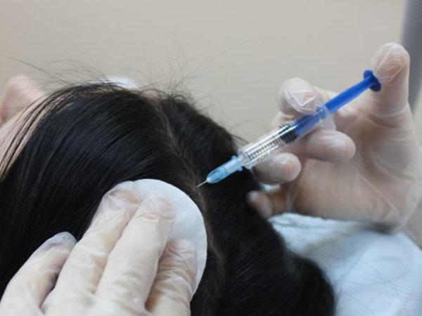 Плазмолифтинг для лечения выпадения волос