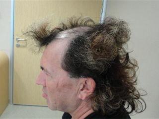 Наращивание волос на голове мужчине