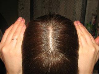 Активатор роста волос эксидерм при алопеции