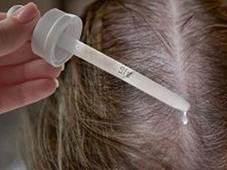 Способ применения миноксидила для волос у мужчин
