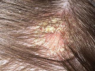 Питание при себорейном дерматите волосистой части головы thumbnail