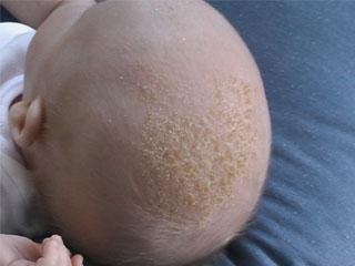 Перхоть или сухая кожа головы у ребенка