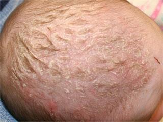 Себорейный дерматит волос у детей