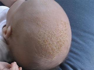 Себорейный дерматит волос у детей