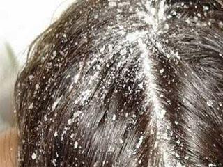 Как вылечить выпадение волос солью