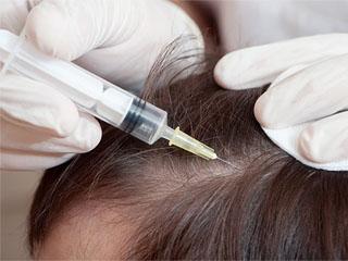 Андрогенетическое выпадение волос у мужчин