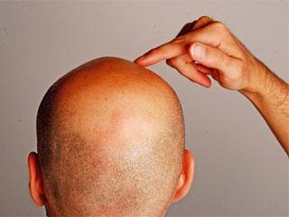 Выпадение волос у мужчин при избытке тестостерона thumbnail
