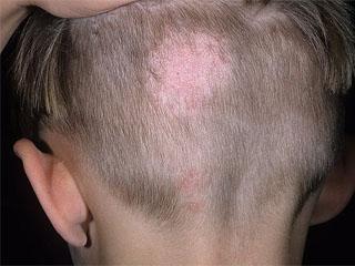 Шелушение волосистой кожи головы