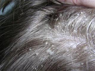 Ампулы волос корал от выпадения волос