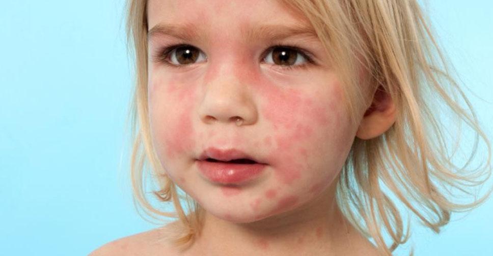 Аллергические заболевания у детей.Симптомы и лечение.