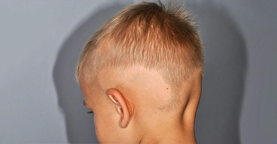 Алопеция причины и лечение очагового и тотального облысения у детей профилактика выпадения волос