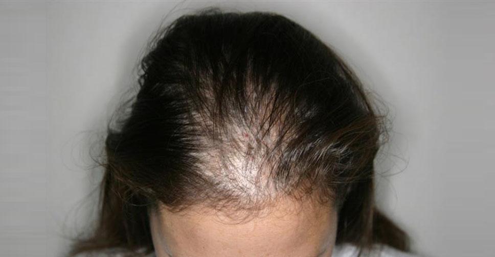 Себорейное выпадение волос, лечение себорейной алопеции
