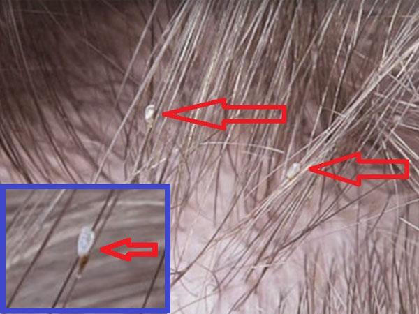 Гниды на волосах: что это такое, как выглядят яйца вшей у человека на голове, фото, какого бывают цвета, виды (пустые, сухие, черные, белые) под микроскопом
